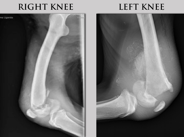 An X ray of both the right and left knee reveals fractures in both legs.
