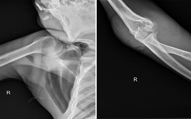 wild mountain gorilla radiograph from x-ray